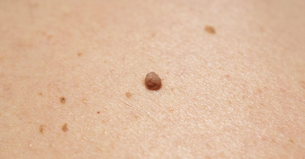 Natural Skin Care: How to Address Age Spots, Moles, Skin Tags, Warts, and Blackheads Naturally