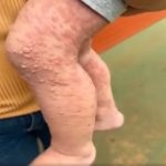 Her Whole Body Was Itchy: What She Thought Was a Common Allergy Was Hiding Something More Serious