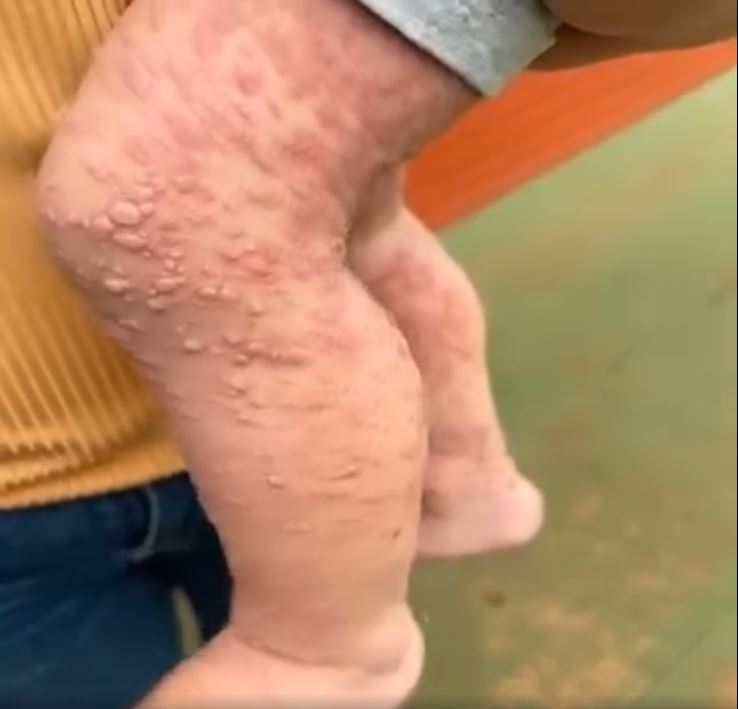 Her Whole Body Was Itchy: What She Thought Was a Common Allergy Was Hiding Something More Serious
