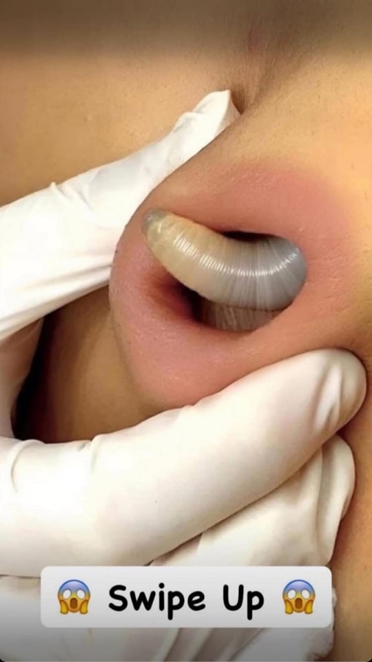 An enormous blackhead