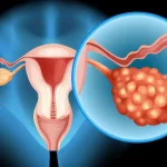 The Hidden Connection Between Two Deadly Cancers Every Woman Should Know