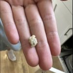 Uncovering the Mystery of Tonsil Stones