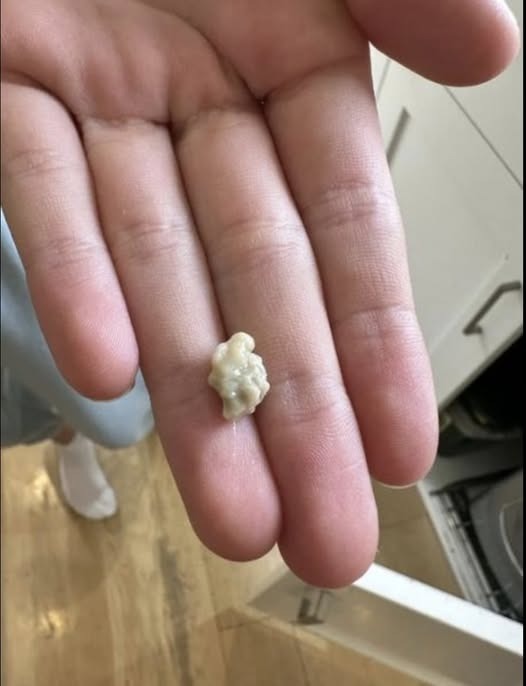 Uncovering the Mystery of Tonsil Stones