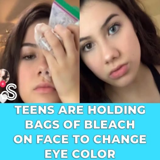 The Dangerous New Trend of Teens Using Bleach to Change Eye Color