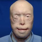 Firefighter’s Life Transformed by Full Face Transplant After Horrific Burns