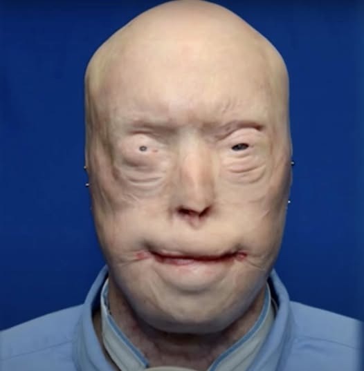 Firefighter’s Life Transformed by Full Face Transplant After Horrific Burns