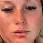 Warning: Woman’s Botox Procedure Led to Partial Paralysis and Long Recovery