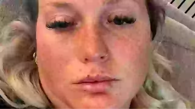 Warning: Woman’s Botox Procedure Led to Partial Paralysis and Long Recovery