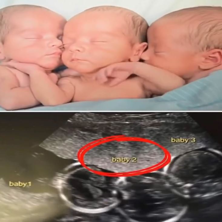 Mother Rushes To Emergency Room To Deliver Triplets: Then Nurses Look Closer At Their Faces And