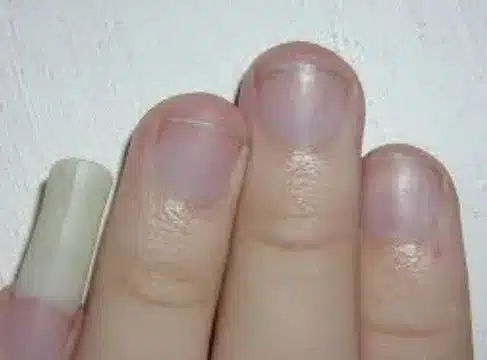 “The Curious Case of the Long Pinky Nail”