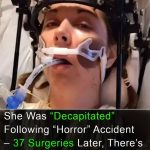Surviving The Impossible: Megan’s Battle with Internal Decapitation
