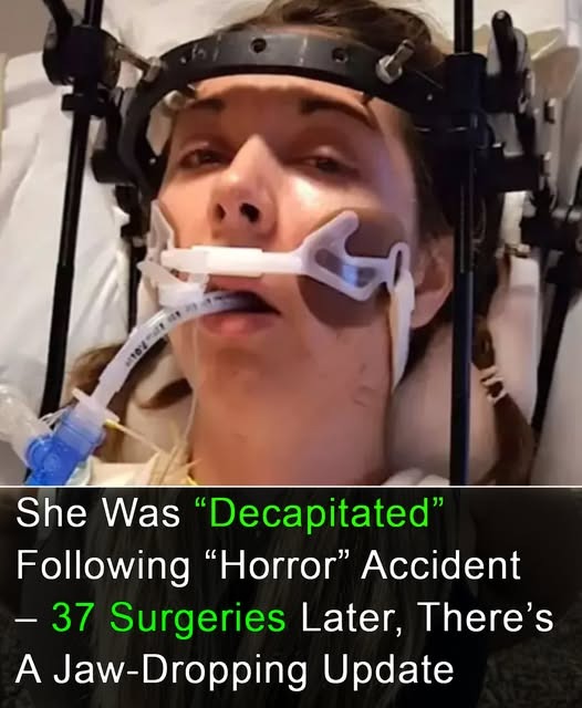 Surviving The Impossible: Megan’s Battle with Internal Decapitation