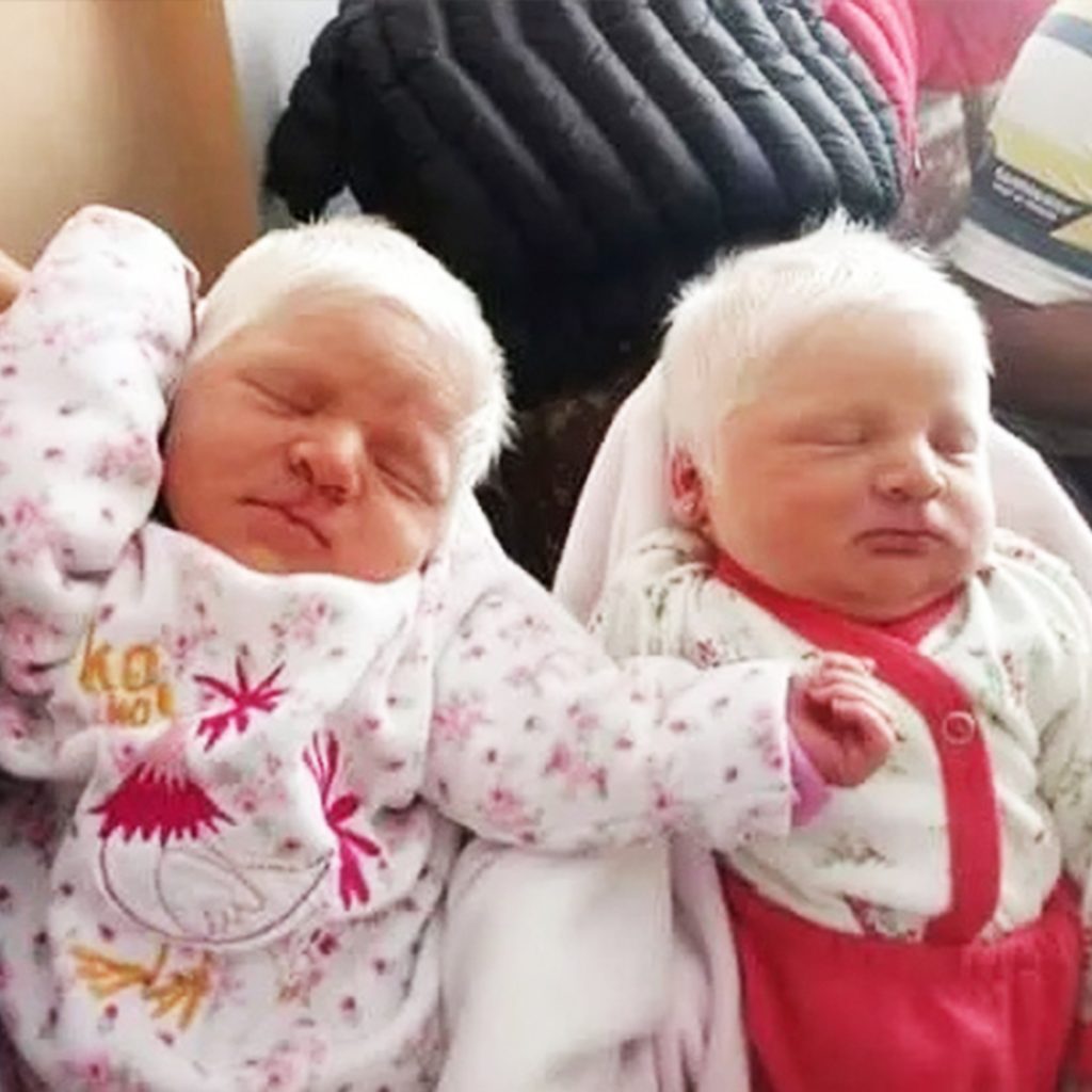 Off The RecordThe First Ever Albino Twins Born In Argentina Will Leave You In Awe