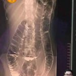 The Hidden Dangers of Chronic Constipation