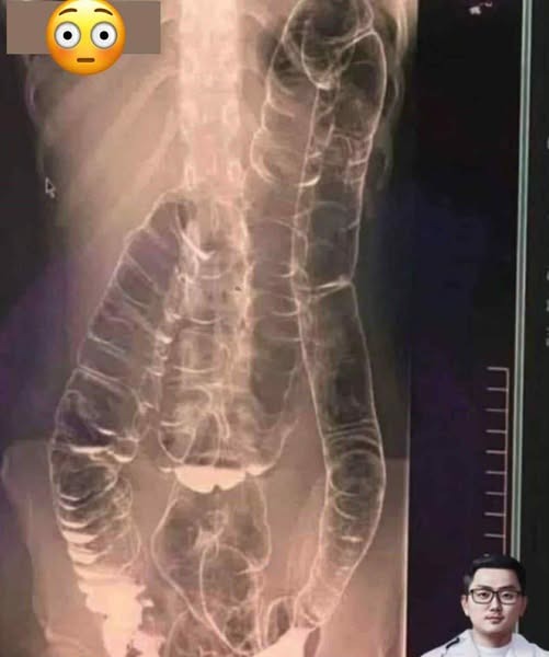 The Hidden Dangers of Chronic Constipation