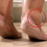 How to Use Vitamin B6 to Combat Leg and Foot Swelling
