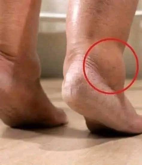How to Use Vitamin B6 to Combat Leg and Foot Swelling