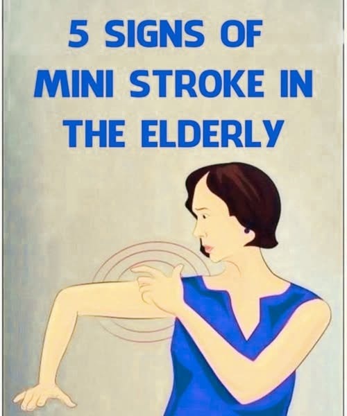 Is It a Mini-Stroke? Recognizing the Signs in an Elderly Loved One