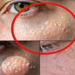 When White Bumps Appear on Your Skin, What Is Your Body Trying to Tell You?