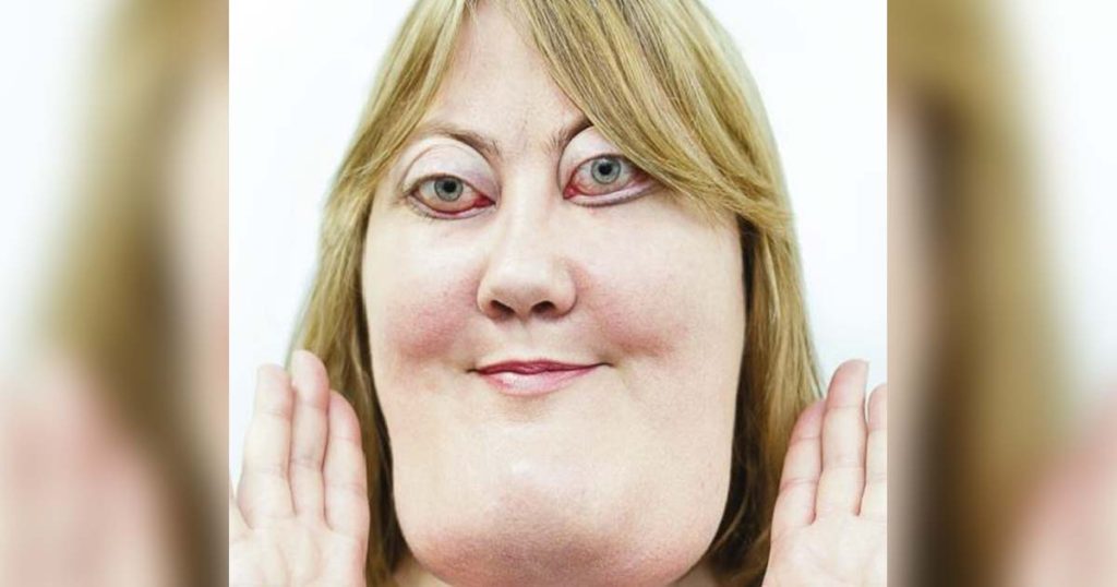 Victoria Wright’s Brave Journey with a Rare Genetic Condition