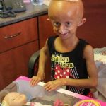 Beandri Booysen: South African Teen with Progeria Passes Away After Inspiring Many