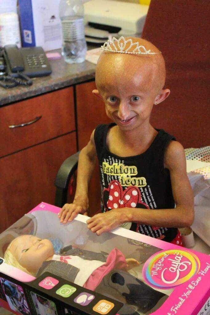 Beandri Booysen: South African Teen with Progeria Passes Away After Inspiring Many