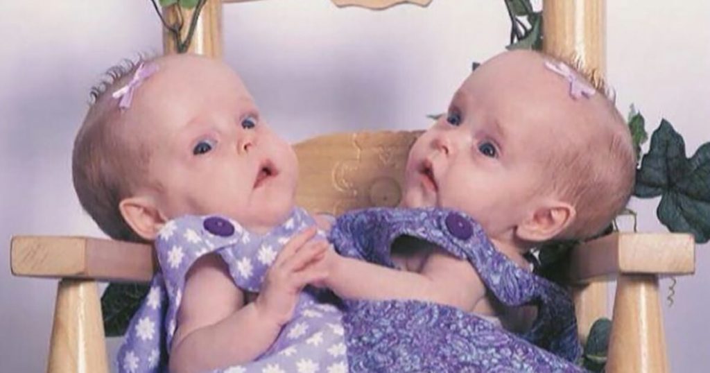 Miracle Twins Kendra and Maliyah Herrin Now Lead Independent Lives After Separation
