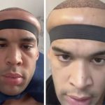 TikTok Creator’s Hair Transplant Journey Takes a Dramatic Turn