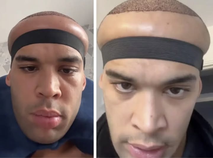 TikTok Creator’s Hair Transplant Journey Takes a Dramatic Turn