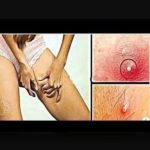 Understanding Oral Cancer
