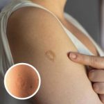 The Story Behind Smallpox Vaccine Scars: A Lasting Legacy of a Medical Breakthrough