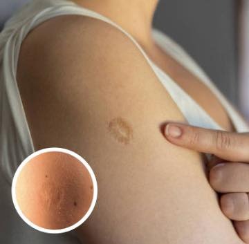 The Story Behind Smallpox Vaccine Scars: A Lasting Legacy of a Medical Breakthrough