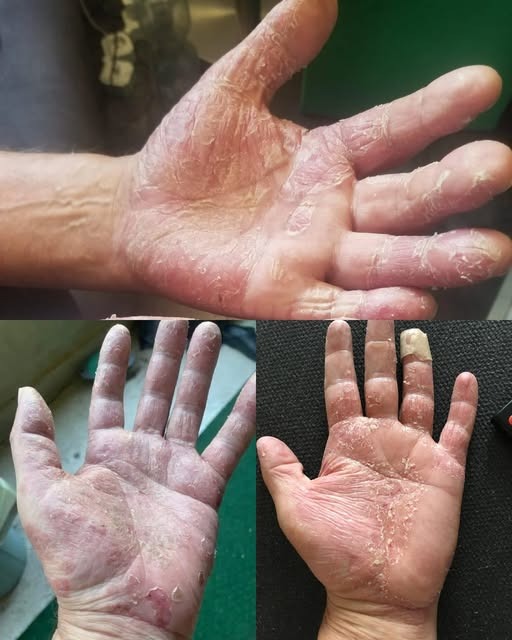 Recognizing and Managing Hand Dermatitis: Causes, Symptoms, and Treatments
