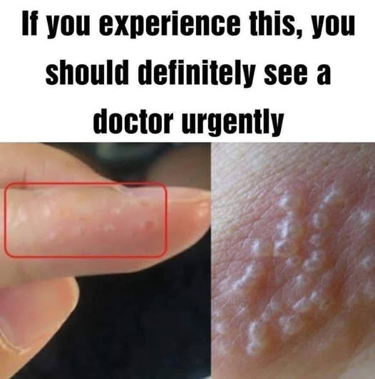 Understanding Dyshidrotic Eczema