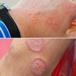 “Below-the-Belt Fire: How to Spot (and Stop) the 5 Rashes That Love Men’s Groins”