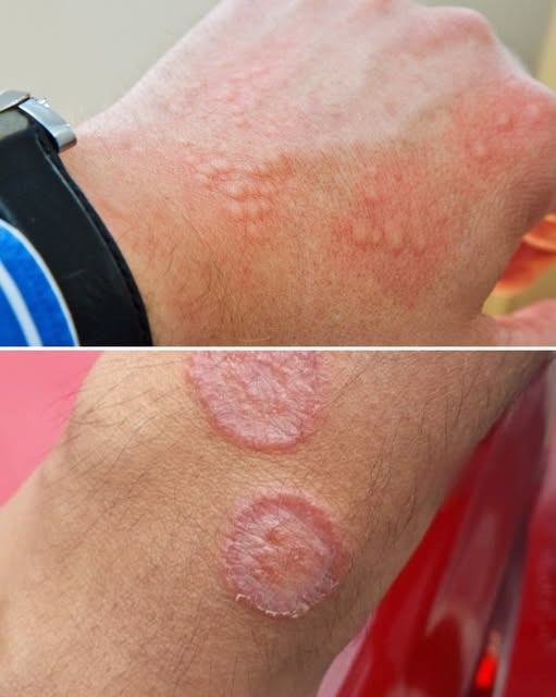 “Below-the-Belt Fire: How to Spot (and Stop) the 5 Rashes That Love Men’s Groins”