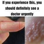 Dyshidrotic Eczema: Warning Signs to Watch For