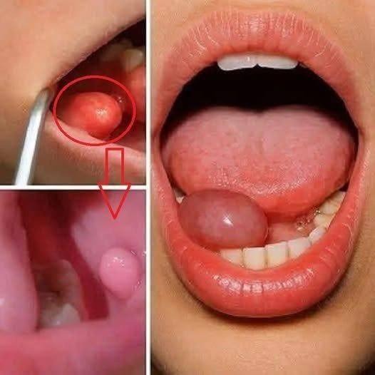 The Mouth Whispers Cancer First—Seven Early Clues You Should Never Ignore