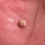 Tonsil Stones: Causes, Symptoms, and When to See a Doctor