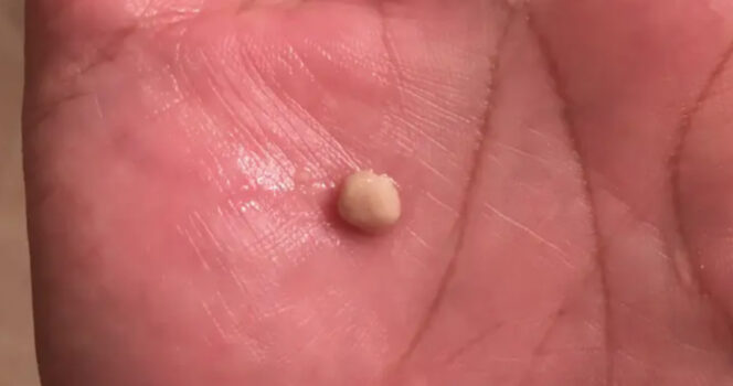 Tonsil Stones: Causes, Symptoms, and When to See a Doctor